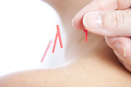 Traditional Acupuncture
