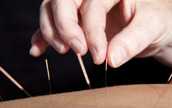 Acupuncture for Back Ache